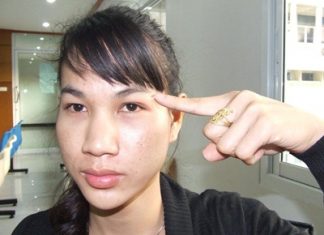 Nopparat Amphanan points to where two ladyboys gave him silicone injections that left him blind in one eye.